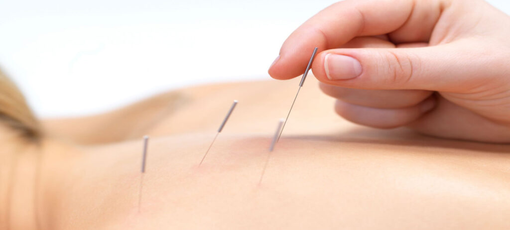Acupuncture and Neuro-Immunological Aspects of Disease